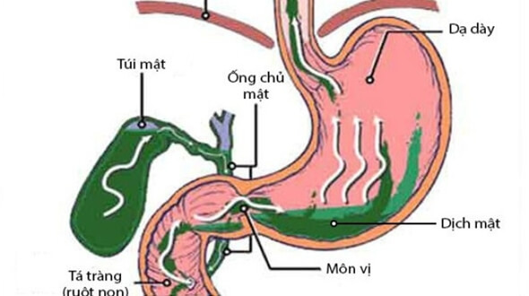 Đắng miệng có thể là biểu hiện của bệnh trào ngược dịch mật